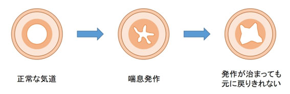 気道のリモデリング1