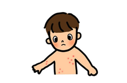 突発性発疹