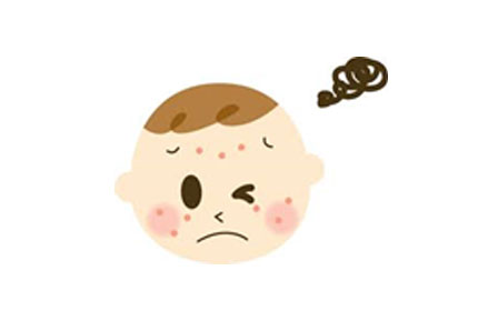 乳児湿疹